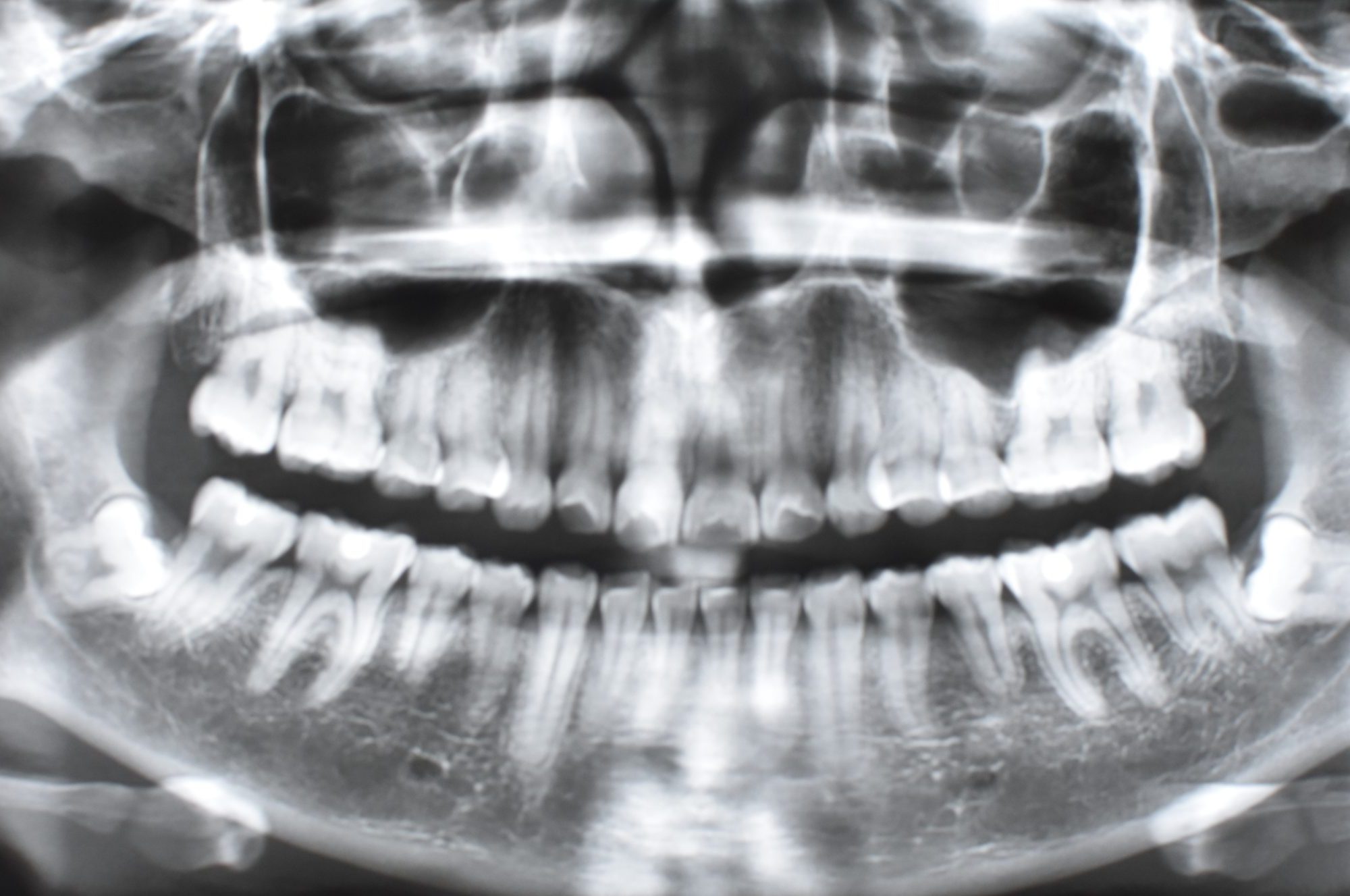 radiografía panorámica cirugía 2