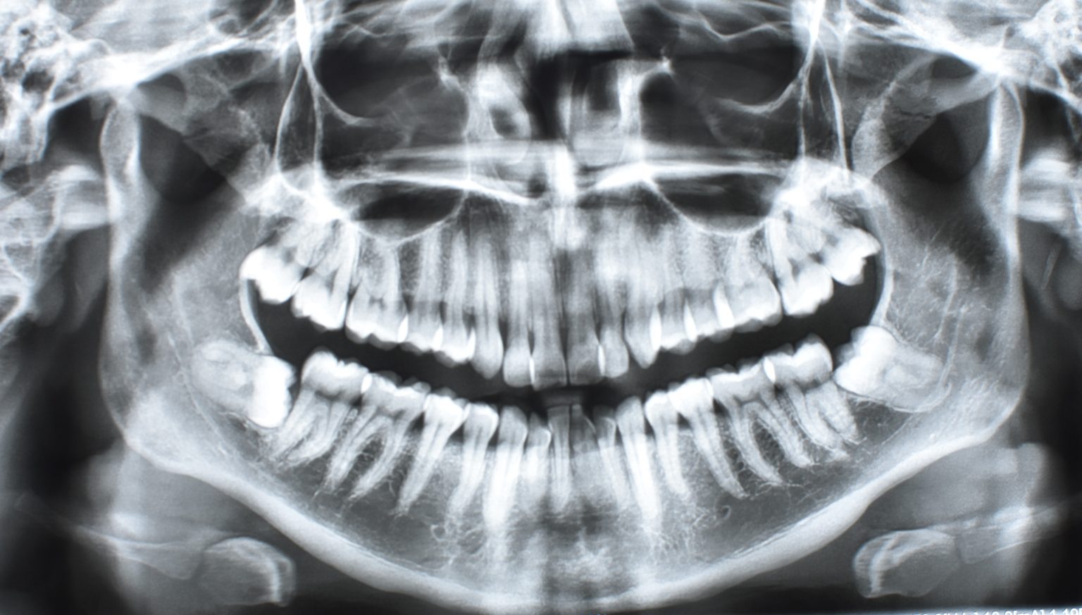 radiografía panorámica cirugía 3